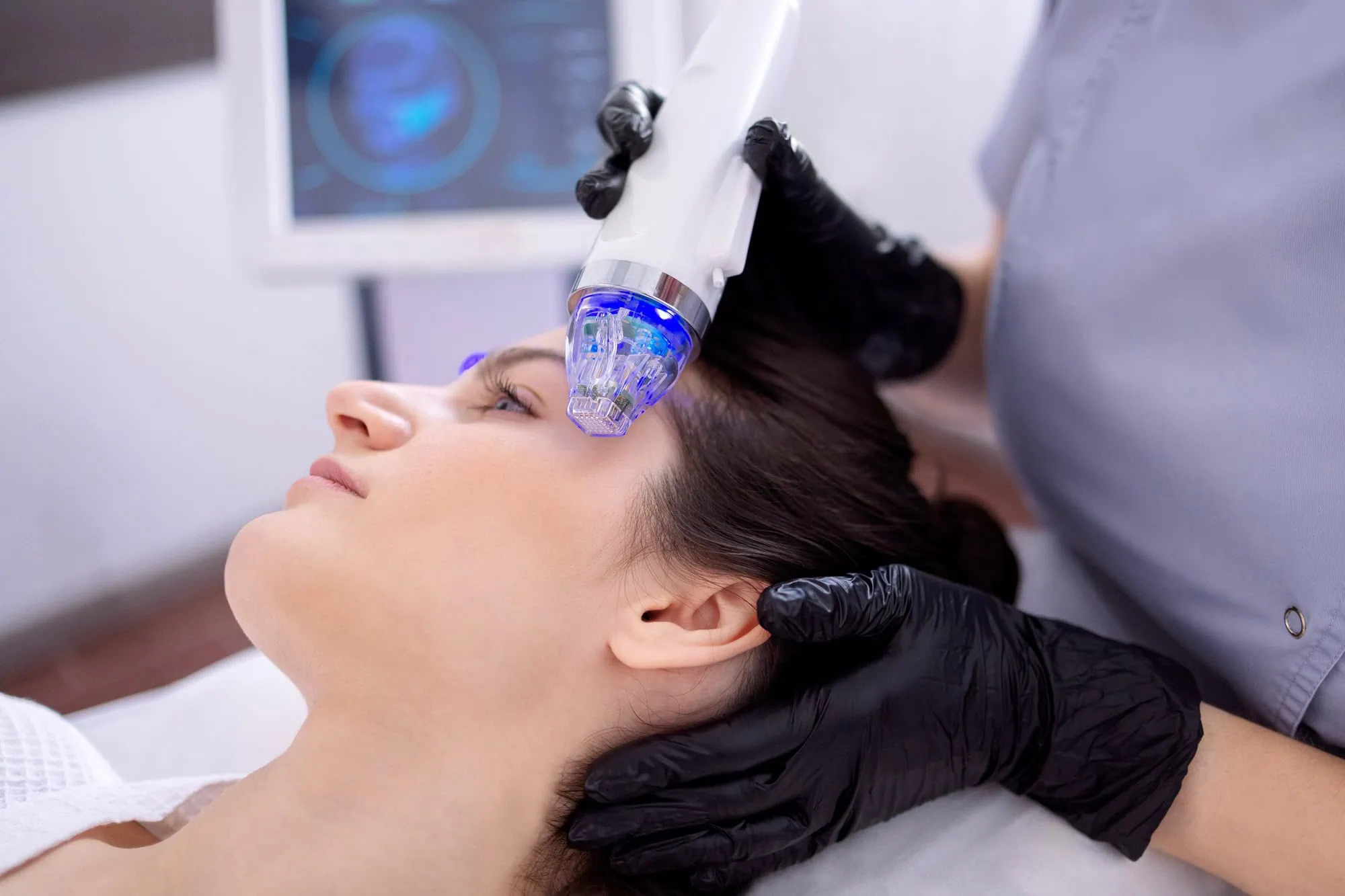 Microneedling Hover